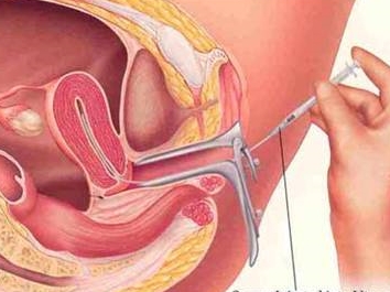 insemina��o artificial de l�sbicas